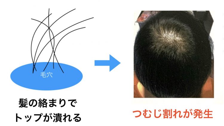 つむじ割れを即日直すカットとは？トップにボリュームをだすヘアリセッター！ - SENJYUプロフェッショナルチーム